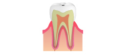 C0：初期の虫歯のイメージ