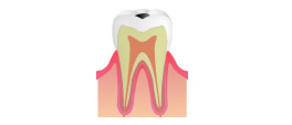 C1：エナメル質の虫歯のイメージ