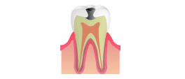 C2：象牙質の虫歯のイメージ