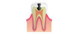 C3：神経に達した虫歯のイメージ