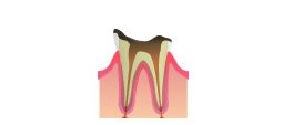 C4：歯根の虫歯のイメージ
