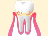 軽度歯周病のイメージ