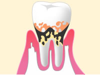 中等度歯周病のイメージ