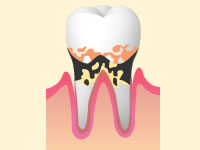 重度歯周病のイメージ