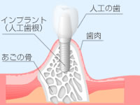 インプラントとはのイメージ