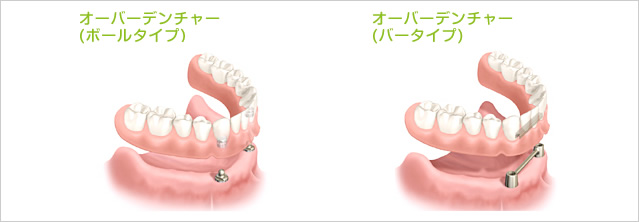 オーバーデンチャーによるインプラント治療のイメージ